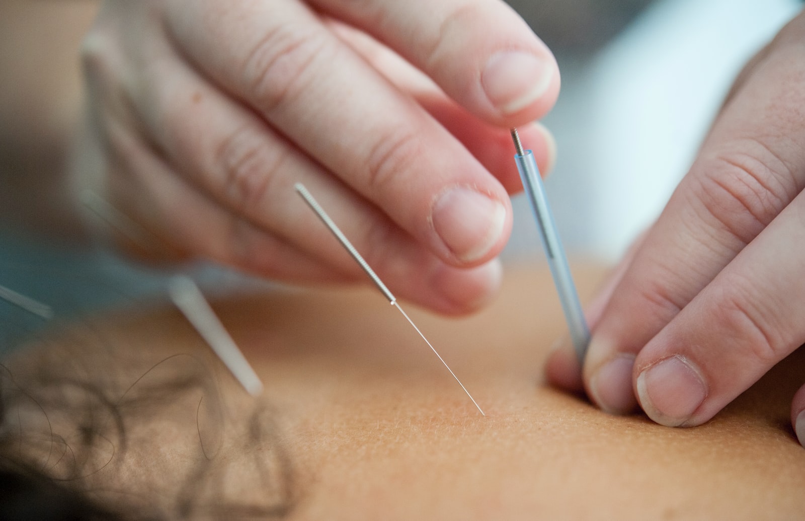 Acupuncture near me: find the best acupuncturists in your area